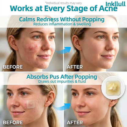 INKLULL® Medical-Grade Hydrocolloid Acne Patch Roll🌿 | Cuttable Overnight Spot Treatment | 2" × 16ft Large Roll