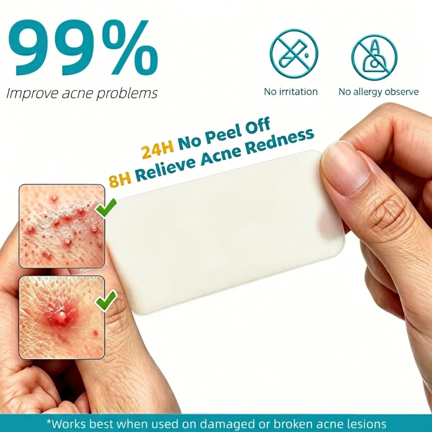 Dimora Medical-Grade Hydrocolloid Acne Patch, Acne spot treatment, Cuttable Overnight Pimple Patch, Acne Mark Fading Patch, Large Size Roll (2 in × 16 ft), Suitable for Acne, Open Wounds, and Sensitive Skin
